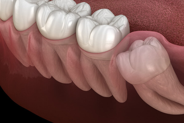 Ağız Kokusu Nedenleri Onur Özen Antakya