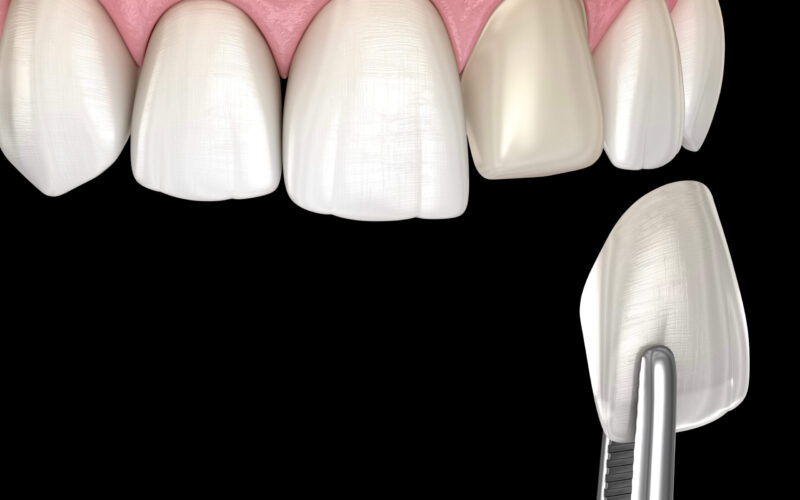 Antakya zirkonyum diş kaplama fiyatları defne