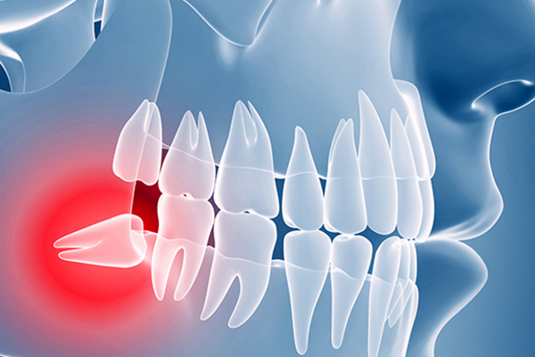 yirmi yaş gömülü diş çekimi